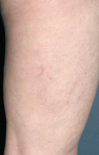 Sclerotherapy after 931542
