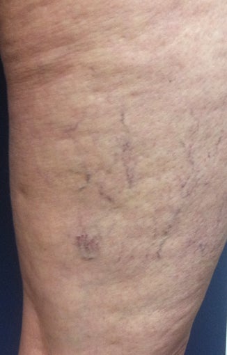 Sclerotherapy before 931542