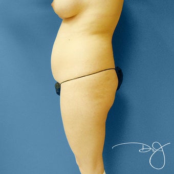 Brazilian Buttock Augmentation 864277