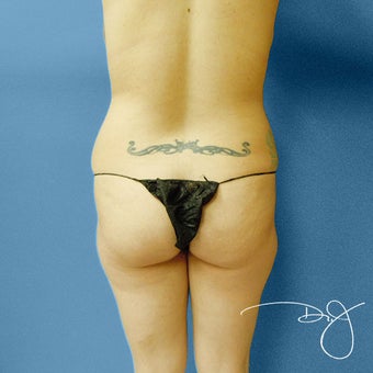 Brazilian Buttock Augmentation before 864277