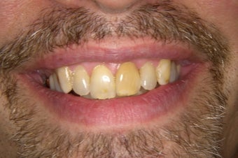 eMax Crowns and Veneers before 751637