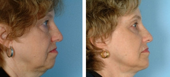Facelift before 1205004