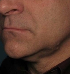 Ultherapy before 241684
