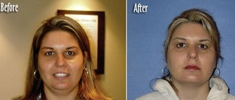 Mesotherapy to reduce double chin before 6516