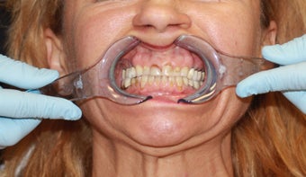 50 year old Patient treated with the All-on-4 Dental Implant Procedure before 1053414