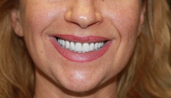 50 year old Patient treated with the All-on-4 Dental Implant Procedure after 1053414