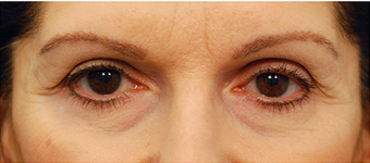 Eye Bag Surgery before 886848