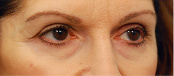 Eye Bag Surgery 886848