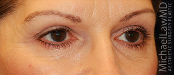 Eye Bag Surgery 886848
