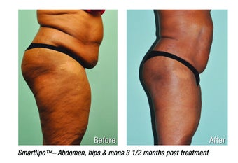 Smartlipo abdomen, hips & mons 3 mos post treatment -61 yr. old after 696012