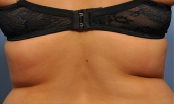 Exilis before 849421