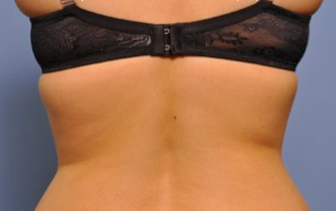 Exilis after 849421