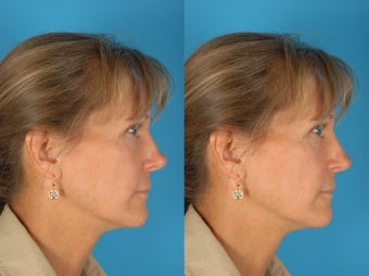 Revision Rhinoplasty Patient before 894216