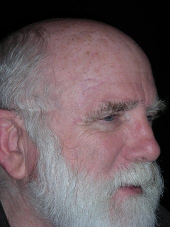 Repair of complex facial laceration after 230938