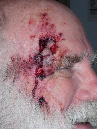 Repair of complex facial laceration before 230938