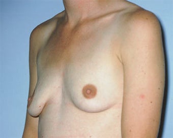 Breast Asymmetry Correction before 281317