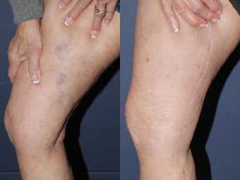Sclerotherapy before 590816