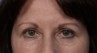 Eyelid Surgery after 302502