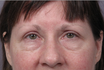 Eyelid Surgery before 302502