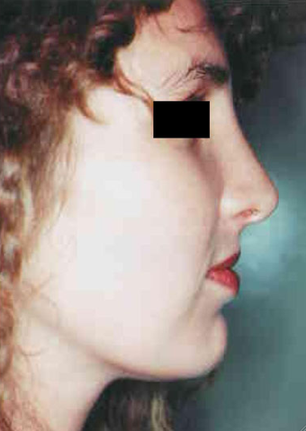 Revision Rhinoplasty after 665079