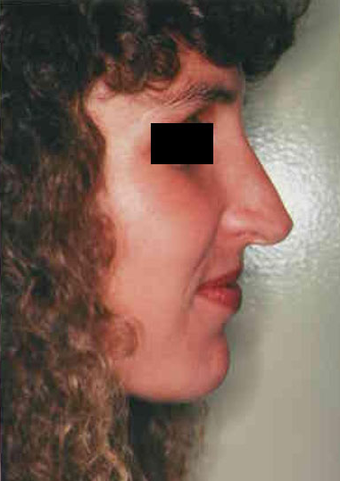 Revision Rhinoplasty before 665079