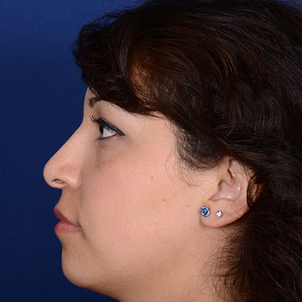 Rhinoplasty after 1357427