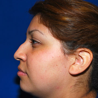 Rhinoplasty before 1357427