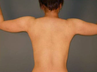 Tumescent Liposuction Under Local Anesthesia. 394782