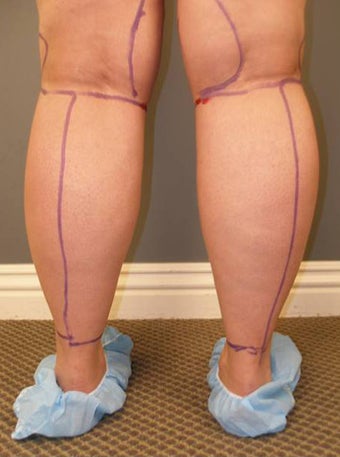 Tumescent Liposuction Under Local Anesthesia. before 394782