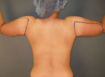 Tumescent Liposuction Under Local Anesthesia. 394782
