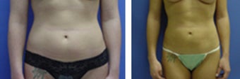 Liposuction to abdomen and flanks before 8999
