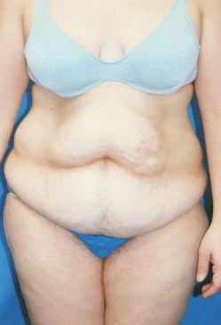 Circumferential Tuck before 863786