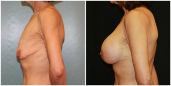 Breast lift with breast augmentation before 1271312
