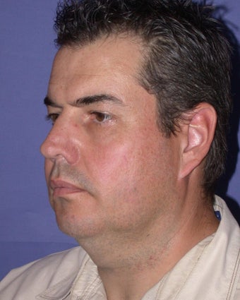 Neck Lift before 902851