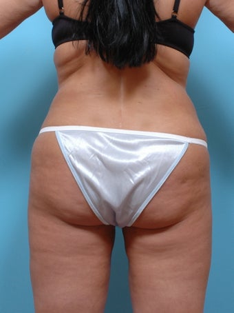 Liposuction after 253608