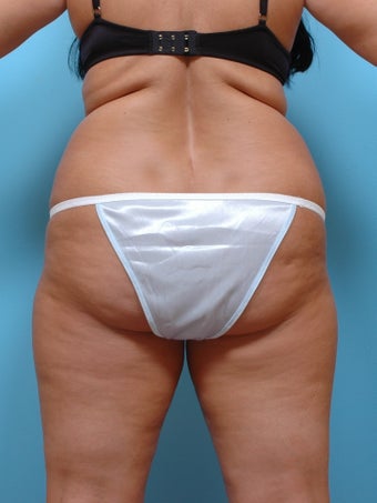 Liposuction before 253608