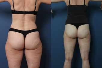 Liposuction- laser assisted (Smart Lipo) of Outer Thighs before 952392