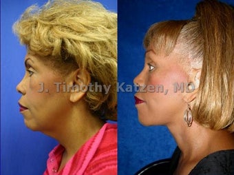 Brow and Neck Lift after massive weight loss before 667218