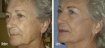 Threadlift to full face for jaw and neck definition before 6822