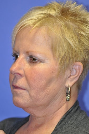 Woman, skin rejuvenation cheeks and neck before 851398