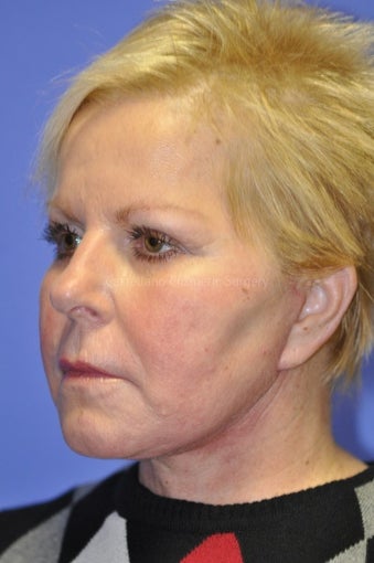 Woman, skin rejuvenation cheeks and neck after 851398