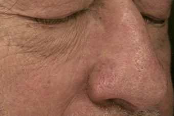 nose vessels treated with pulsed dye laser (PDL) after 821610