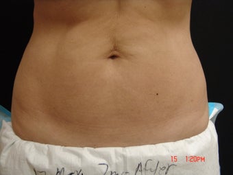 Coolsculpting Abdomen after 340103