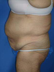 Circumferential Tuck 863774
