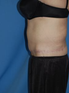 Circumferential Tuck 863774