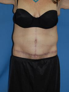 Circumferential Tuck after 863774