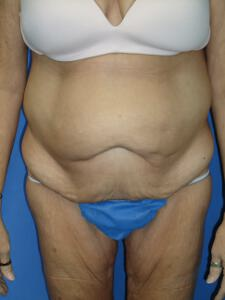 Circumferential Tuck before 863774