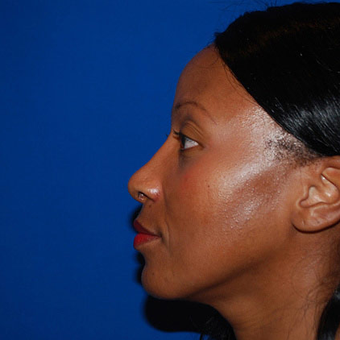 Chin Augmentation after 944863