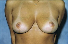 Mastopexy (breastlift) front view after 83399