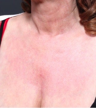 52 year old woman who underwent décolletage (cleavage) rejuvenation after 1100628